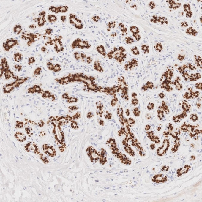 IHC staining of human breast using 87051-3-RR (same clone as 87051-3-PBS) Immunohistochemistry (IHC) staining of human breast tissue using SOX10 Recombinant monoclonal antibody (87051-3-RR)