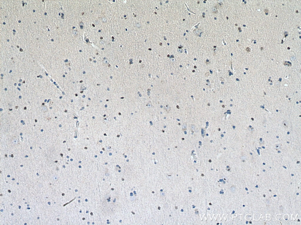 IHC staining of human gliomas using 11064-1-AP