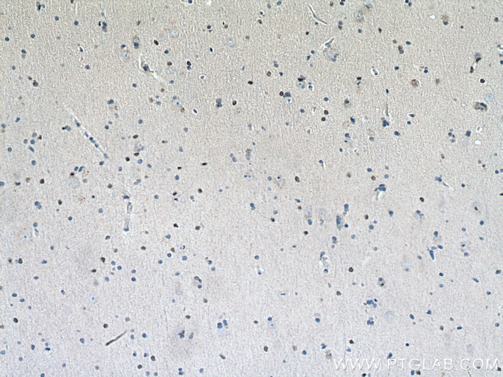 Immunohistochemistry (IHC) staining of human gliomas tissue using SOX2 Polyclonal antibody (11064-1-AP)