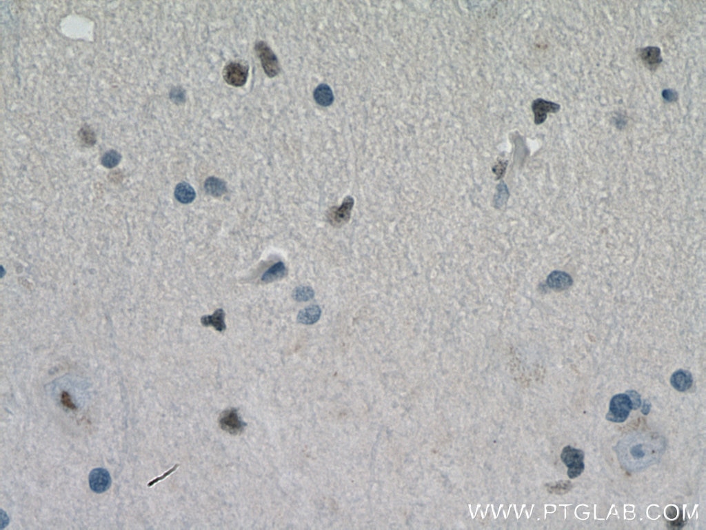 Immunohistochemistry (IHC) staining of human gliomas tissue using SOX2 Polyclonal antibody (11064-1-AP)