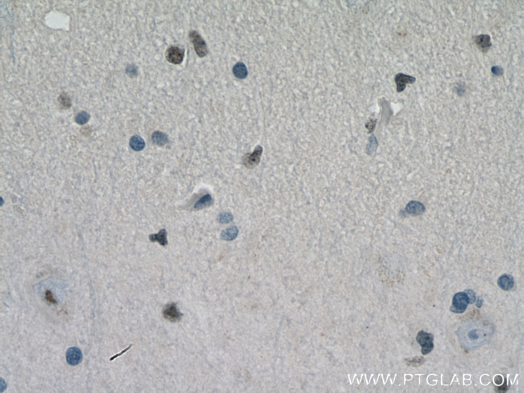 IHC staining of human gliomas using 11064-1-AP