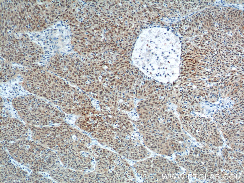 Immunohistochemistry (IHC) staining of human lung cancer tissue using SOX2 Polyclonal antibody (11064-1-AP)