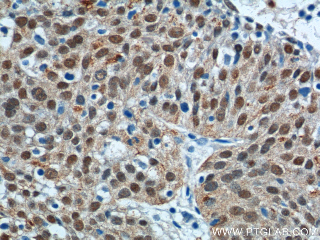 Immunohistochemistry (IHC) staining of human lung cancer tissue using SOX2 Polyclonal antibody (11064-1-AP)