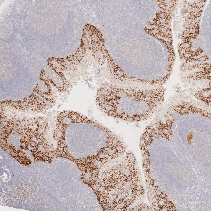IHC staining of human tonsillitis using 66411-1-Ig Immunohistochemistry (IHC) staining of human tonsillitis tissue using SOX2 Monoclonal antibody (66411-1-Ig)