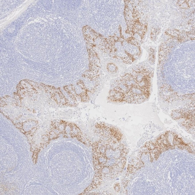 IHC staining of human tonsillitis using 66411-1-Ig Immunohistochemistry (IHC) staining of human tonsillitis tissue using SOX2 Monoclonal antibody (66411-1-Ig)