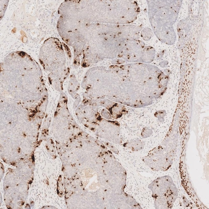 IHC staining of human skin cancer using 66411-1-Ig Immunohistochemistry (IHC) staining of human skin cancer tissue using SOX2 Monoclonal antibody (66411-1-Ig)