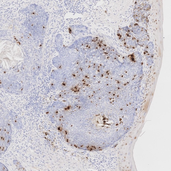IHC staining of human skin cancer using 66411-1-Ig Immunohistochemistry (IHC) staining of human skin cancer tissue using SOX2 Monoclonal antibody (66411-1-Ig)