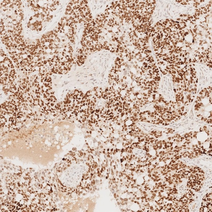 IHC staining of human ovary cancer using 66411-1-Ig Immunohistochemistry (IHC) staining of human ovary cancer tissue using SOX2 Monoclonal antibody (66411-1-Ig)