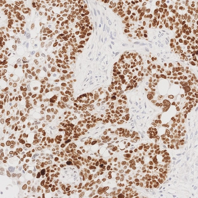 IHC staining of human ovary cancer using 66411-1-Ig Immunohistochemistry (IHC) staining of human ovary cancer tissue using SOX2 Monoclonal antibody (66411-1-Ig)