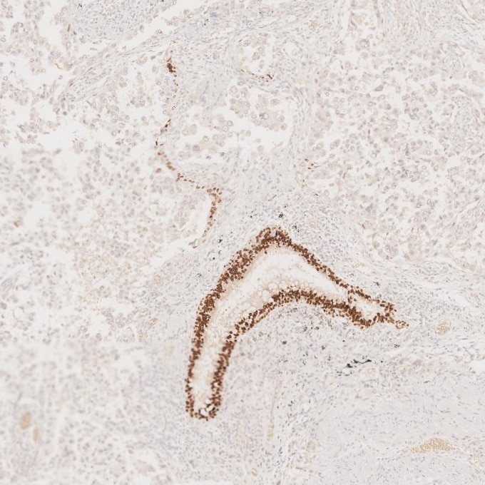 IHC staining of human lung cancer using 66411-1-Ig Immunohistochemistry (IHC) staining of human lung cancer tissue using SOX2 Monoclonal antibody (66411-1-Ig)