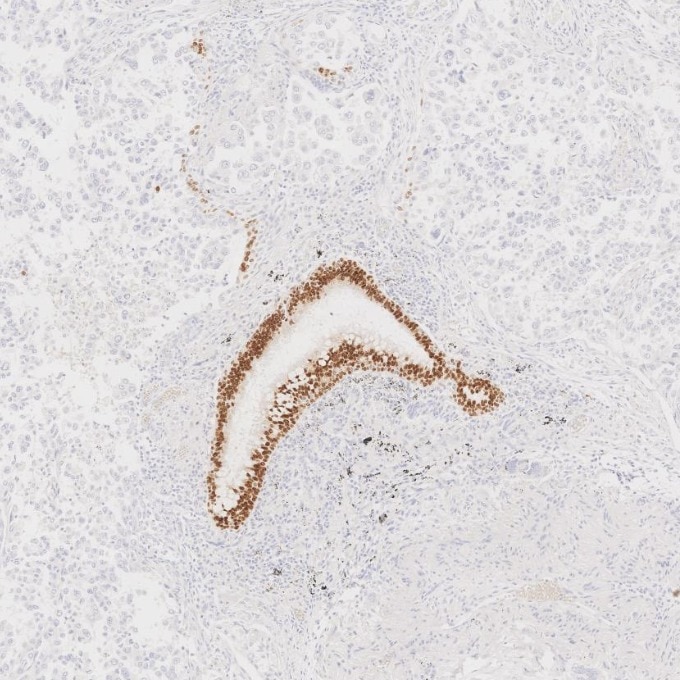 IHC staining of human lung cancer using 66411-1-Ig Immunohistochemistry (IHC) staining of human lung cancer tissue using SOX2 Monoclonal antibody (66411-1-Ig)