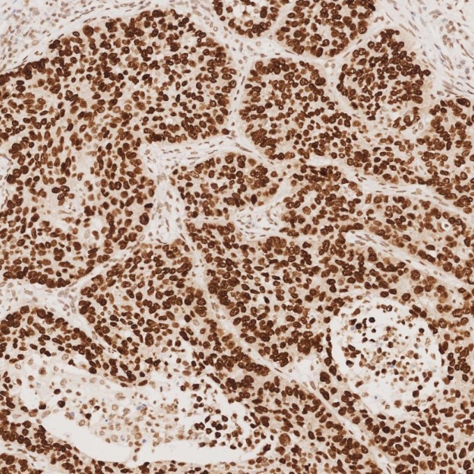 IHC staining of human lung cancer using 66411-1-Ig Immunohistochemistry (IHC) staining of human lung cancer tissue using SOX2 Monoclonal antibody (66411-1-Ig)