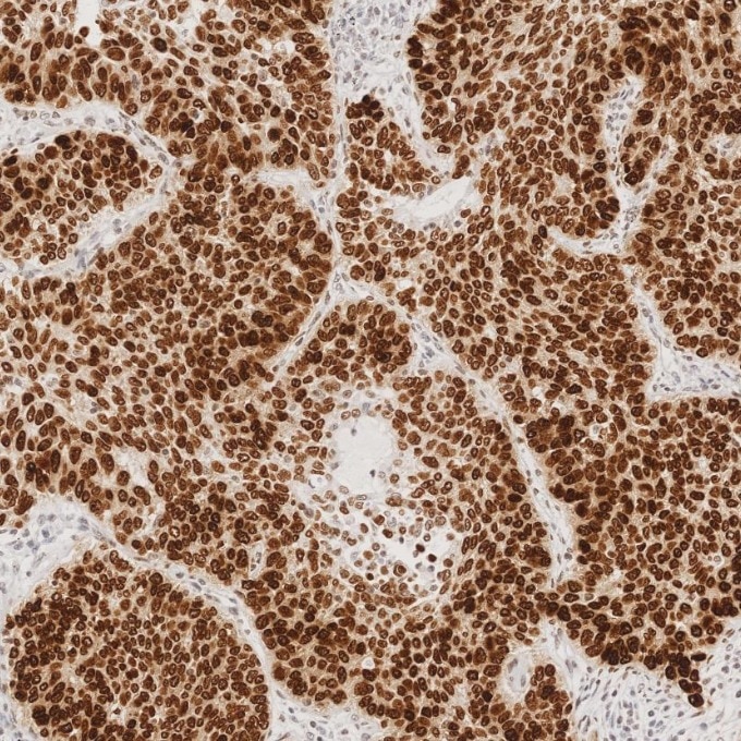 IHC staining of human lung cancer using 66411-1-Ig Immunohistochemistry (IHC) staining of human lung cancer tissue using SOX2 Monoclonal antibody (66411-1-Ig)