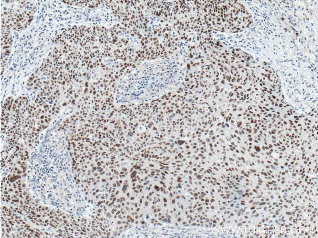 Immunohistochemistry (IHC) staining of human lung cancer tissue using SOX2 Monoclonal antibody (66411-1-Ig)
