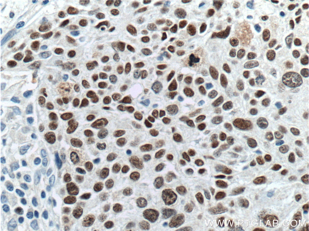 Immunohistochemistry (IHC) staining of human lung cancer tissue using SOX2 Monoclonal antibody (66411-1-Ig)