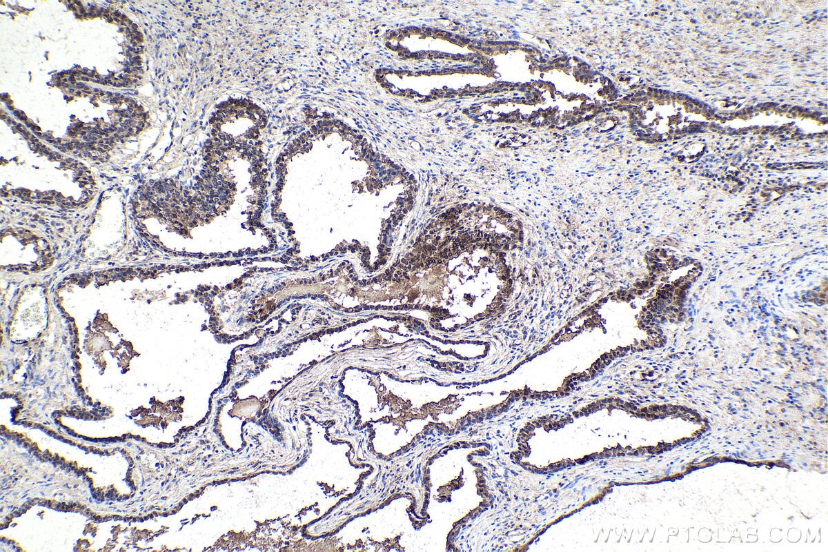 Immunohistochemistry (IHC) staining of human prostate cancer tissue using SOX7 Polyclonal antibody (23925-1-AP)