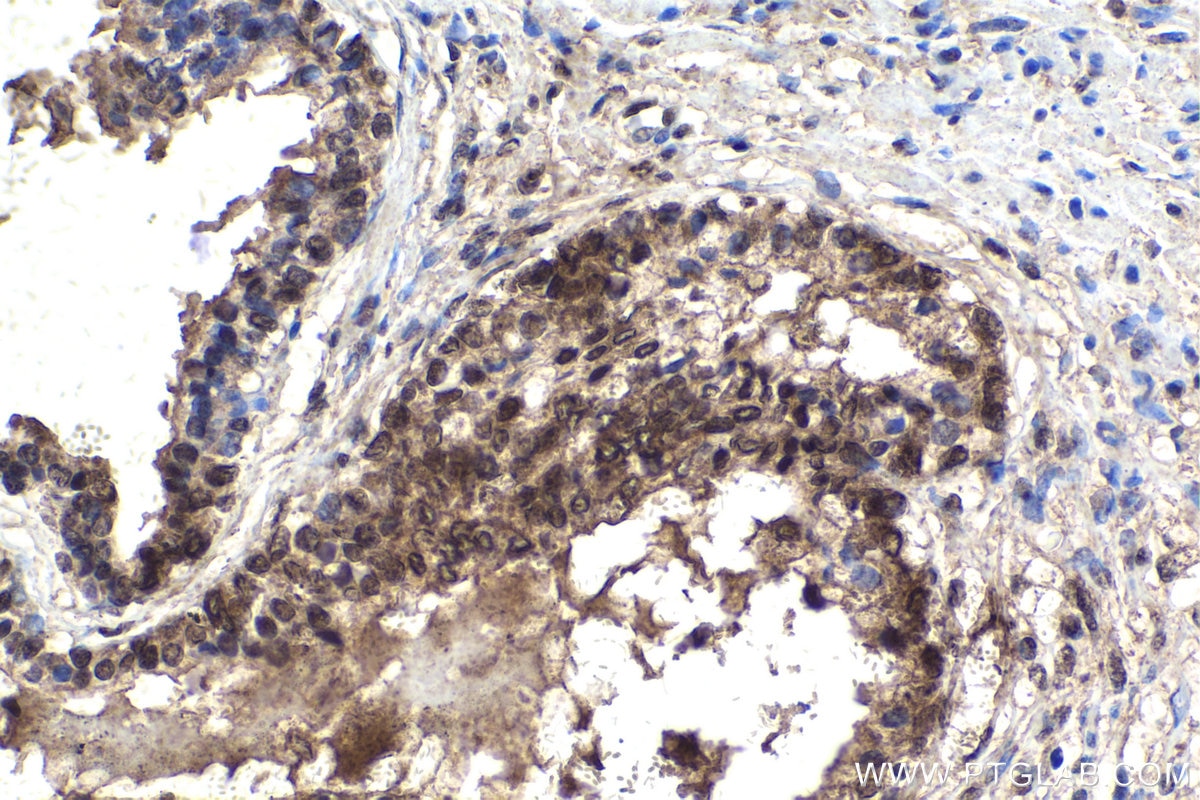 Immunohistochemistry (IHC) staining of human prostate cancer tissue using SOX7 Polyclonal antibody (23925-1-AP)