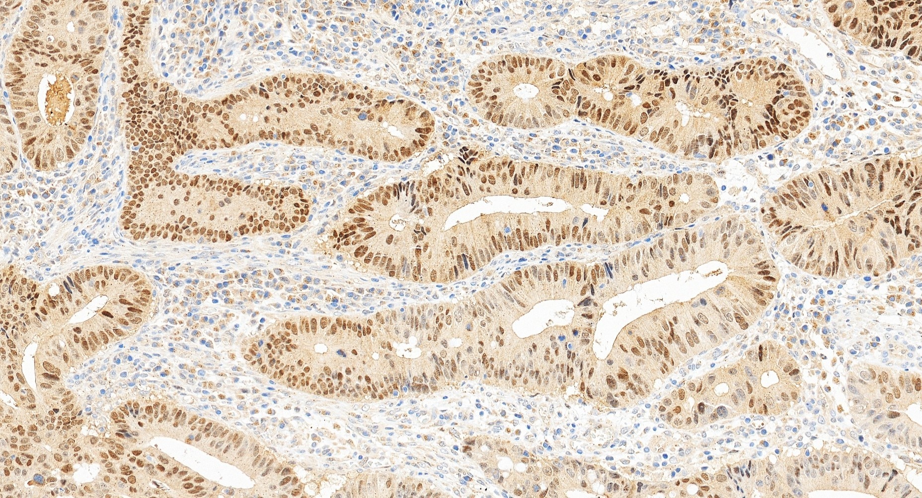 IHC staining of human colon cancer using 27526-1-AP Immunohistochemistry (IHC) staining of human colon cancer tissue using SOX9 Polyclonal antibody (27526-1-AP)