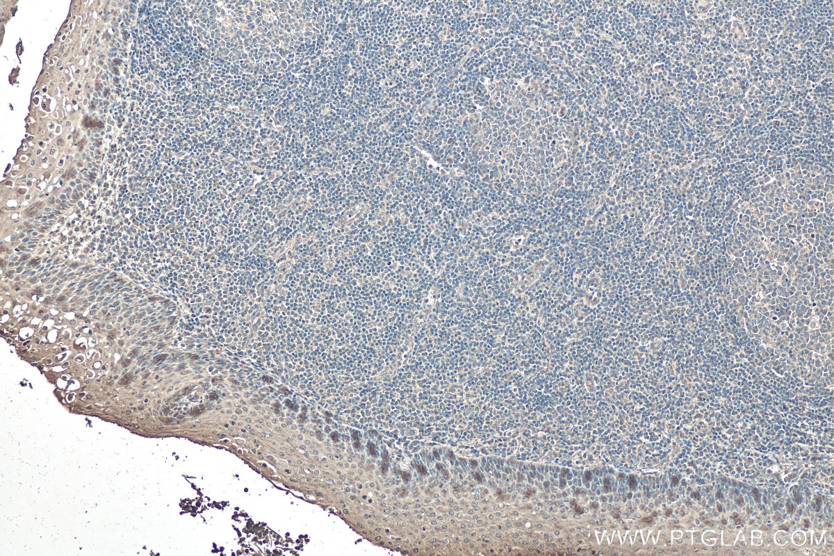 Immunohistochemistry (IHC) staining of human tonsillitis tissue using SOX9 Monoclonal antibody (67439-1-Ig)