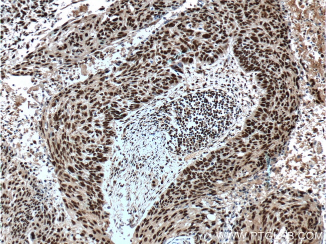 Immunohistochemistry (IHC) staining of human lung cancer tissue using SP1 Polyclonal antibody (21962-1-AP)