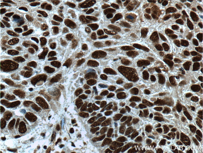 Immunohistochemistry (IHC) staining of human lung cancer tissue using SP1 Polyclonal antibody (21962-1-AP)