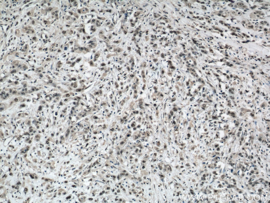 IHC staining of human stomach cancer using 21962-1-AP