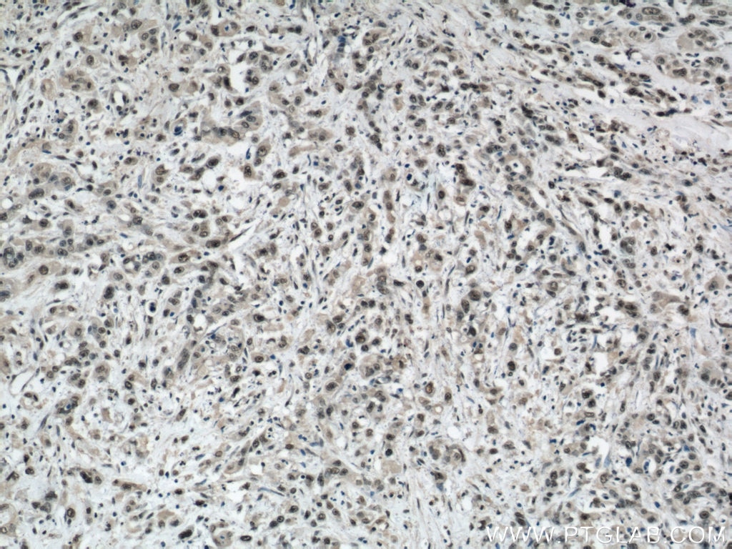 Immunohistochemistry (IHC) staining of human stomach cancer tissue using SP1 Polyclonal antibody (21962-1-AP)