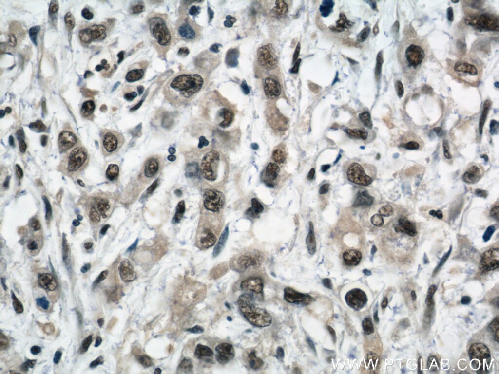 Immunohistochemistry (IHC) staining of human stomach cancer tissue using SP1 Polyclonal antibody (21962-1-AP)