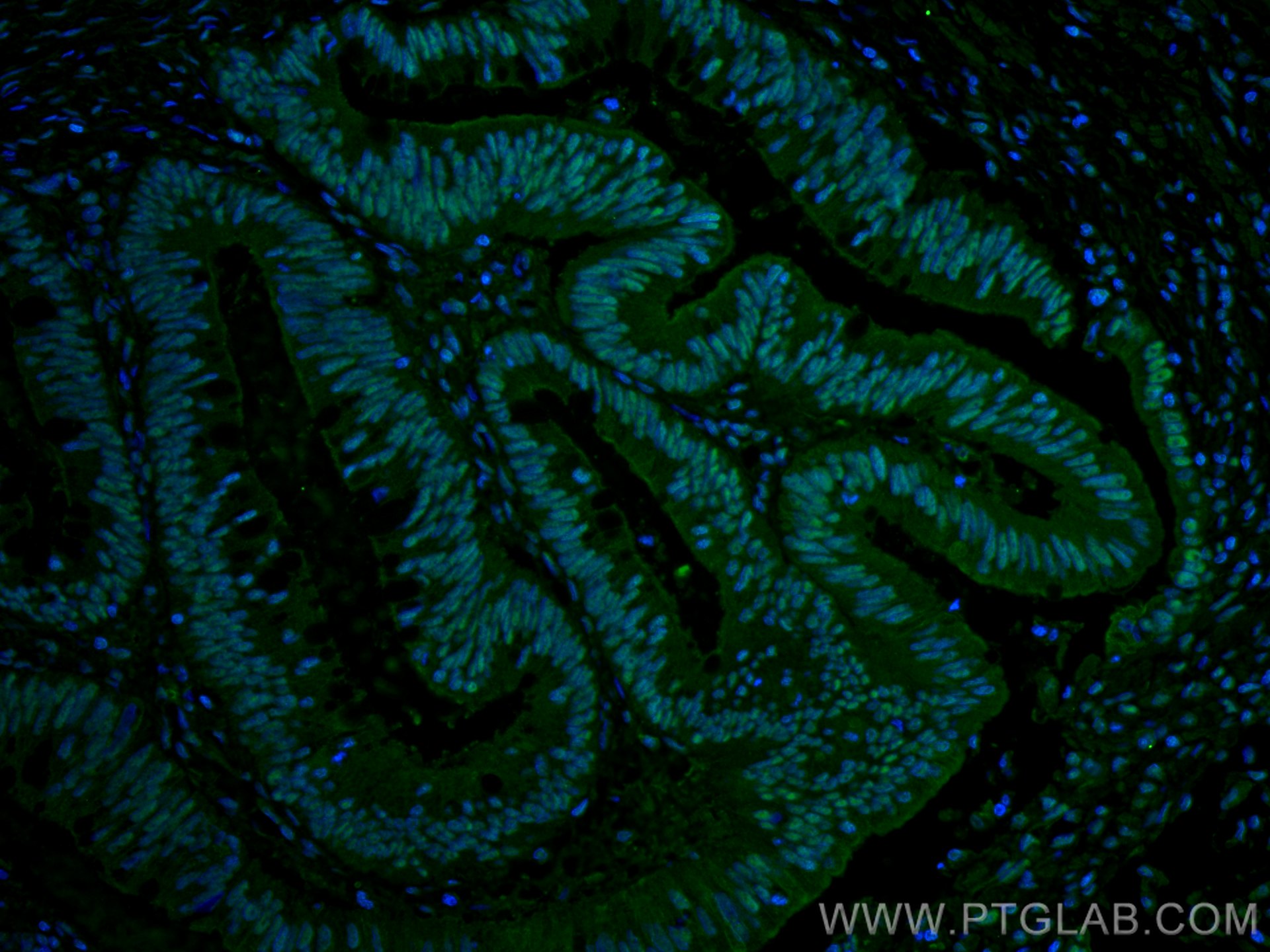 Immunofluorescence (IF) / fluorescent staining of human colon cancer tissue using SP1 Monoclonal antibody (66508-1-Ig)