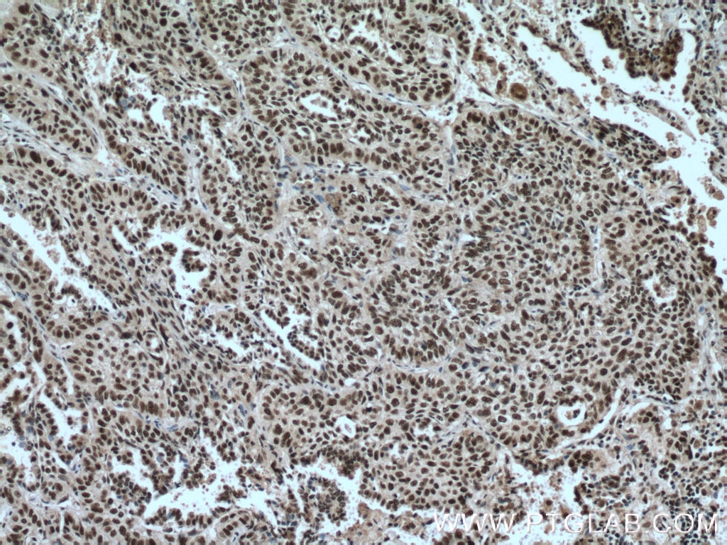Immunohistochemistry (IHC) staining of human lung cancer tissue using SP1 Monoclonal antibody (66508-1-Ig)