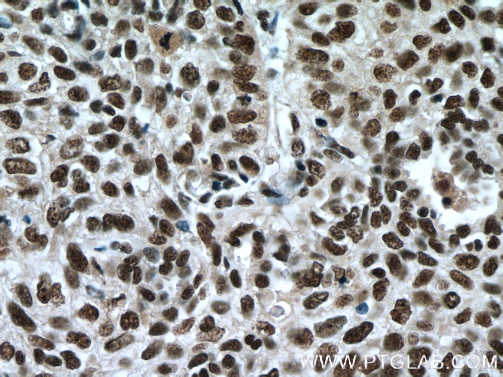 Immunohistochemistry (IHC) staining of human lung cancer tissue using SP1 Monoclonal antibody (66508-1-Ig)