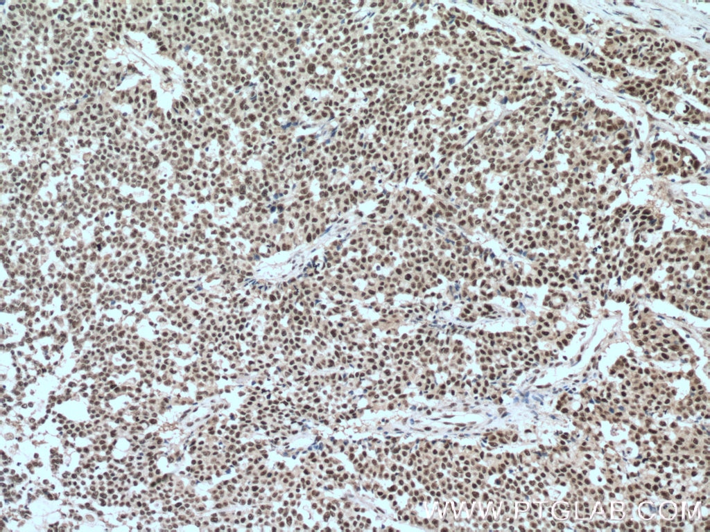 Immunohistochemistry (IHC) staining of human colon cancer tissue using SP1 Monoclonal antibody (66508-1-Ig)