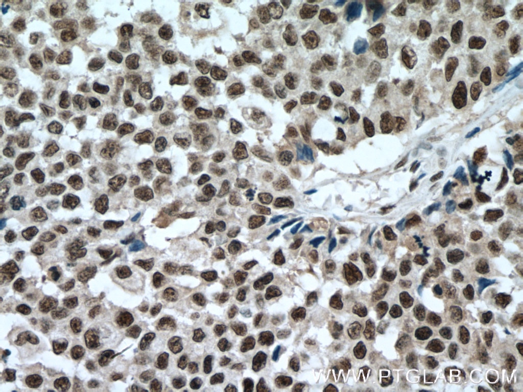 Immunohistochemistry (IHC) staining of human colon cancer tissue using SP1 Monoclonal antibody (66508-1-Ig)