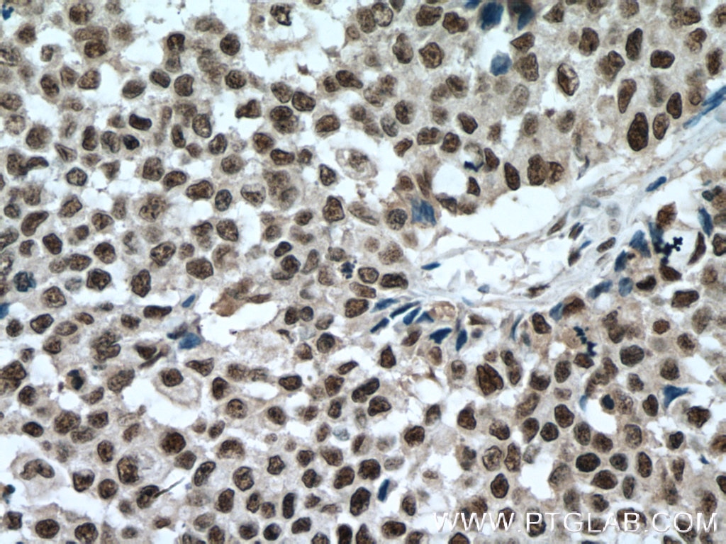 IHC staining of human colon cancer using 66508-1-Ig