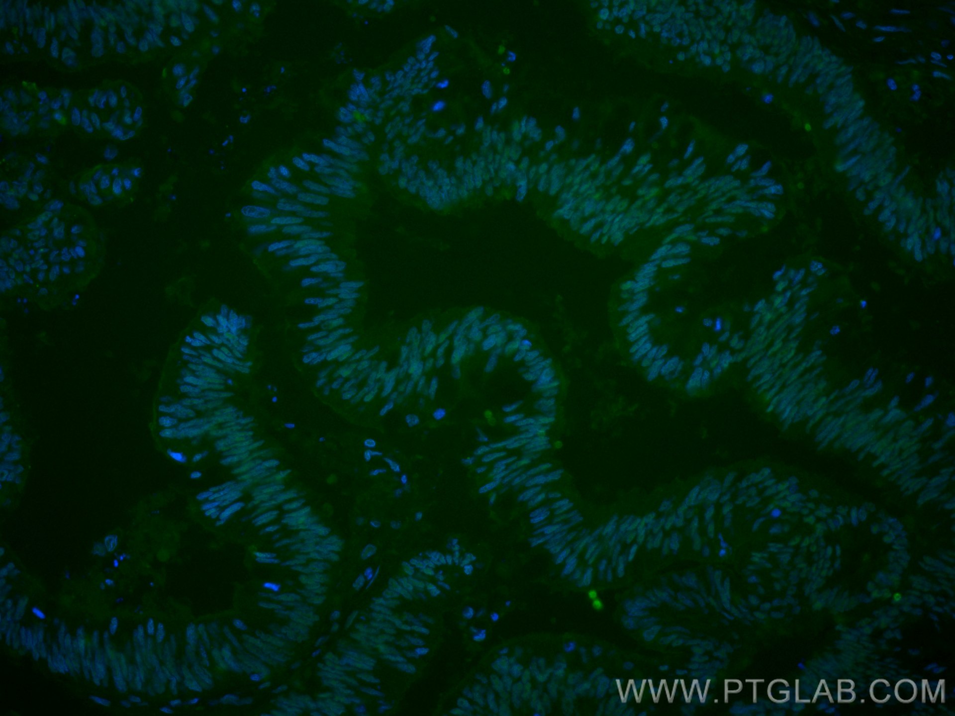Immunofluorescence (IF) / fluorescent staining of human colon cancer tissue using CoraLite® Plus 488-conjugated SP1 Monoclonal antib (CL488-66508)