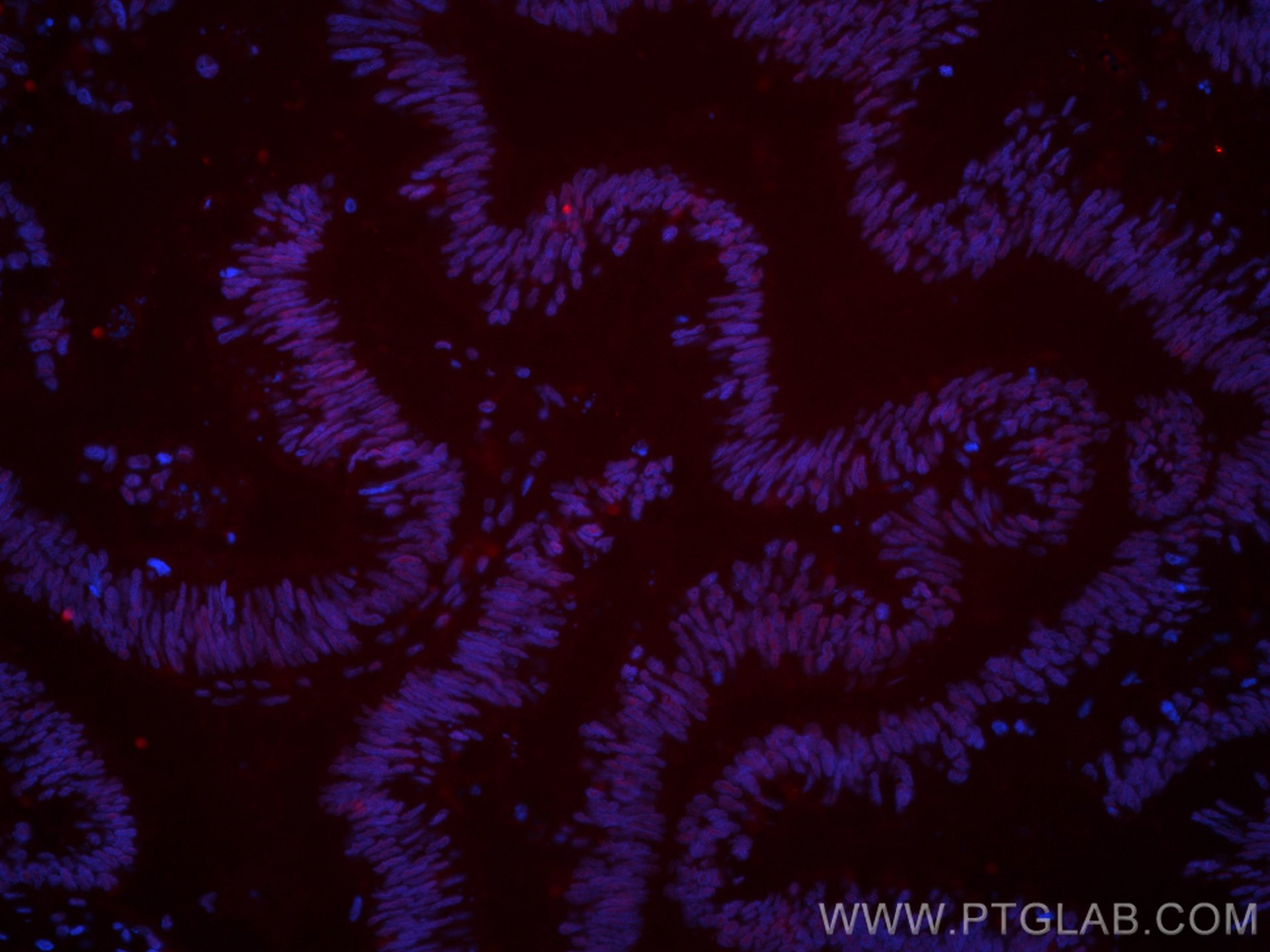 Immunofluorescence (IF) / fluorescent staining of human colon cancer tissue using CoraLite®594-conjugated SP1 Monoclonal antibody (CL594-66508)