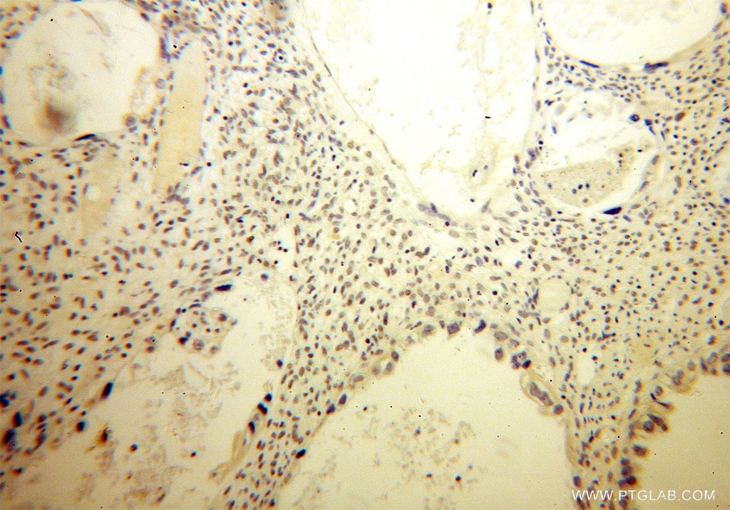 Immunohistochemistry (IHC) staining of human ovary tumor tissue using SP100 Polyclonal antibody (11377-1-AP)