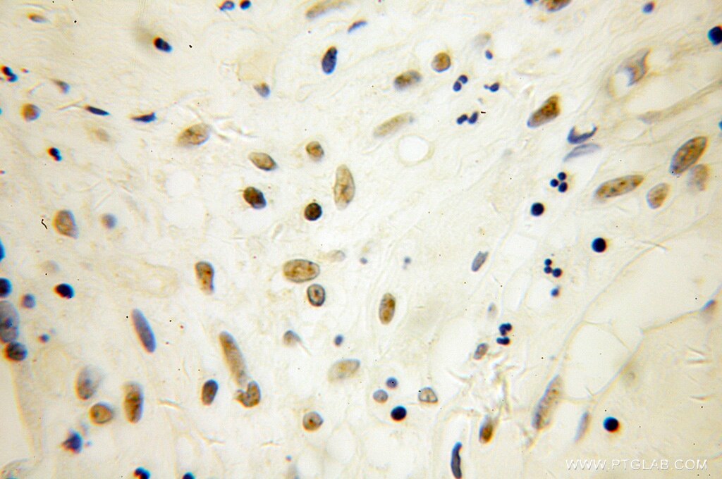 IHC staining of human ovary tumor using 11377-1-AP