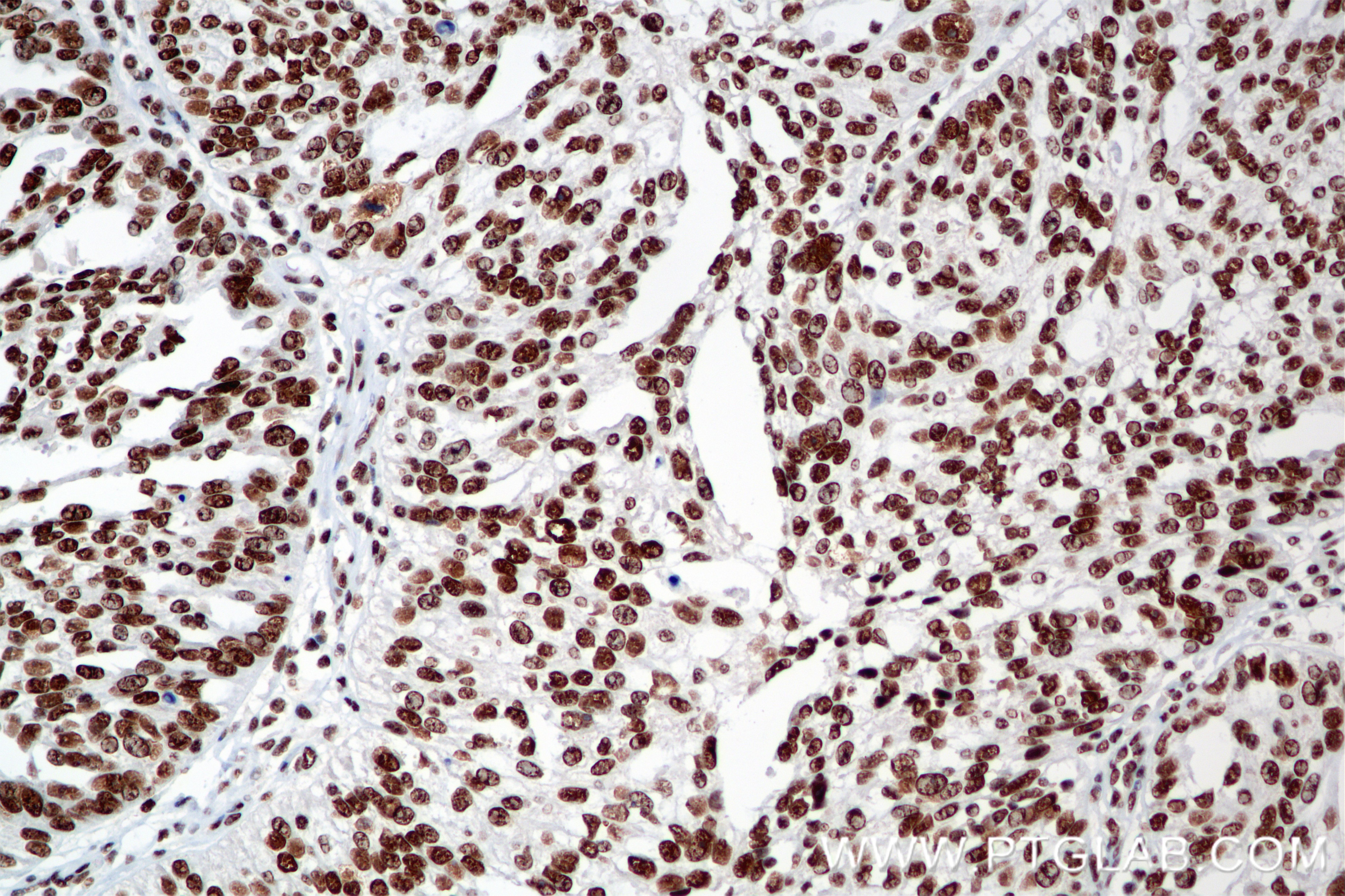 Immunohistochemistry (IHC) staining of human ovary cancer tissue using SP3 Recombinant antibody (85050-1-RR)
