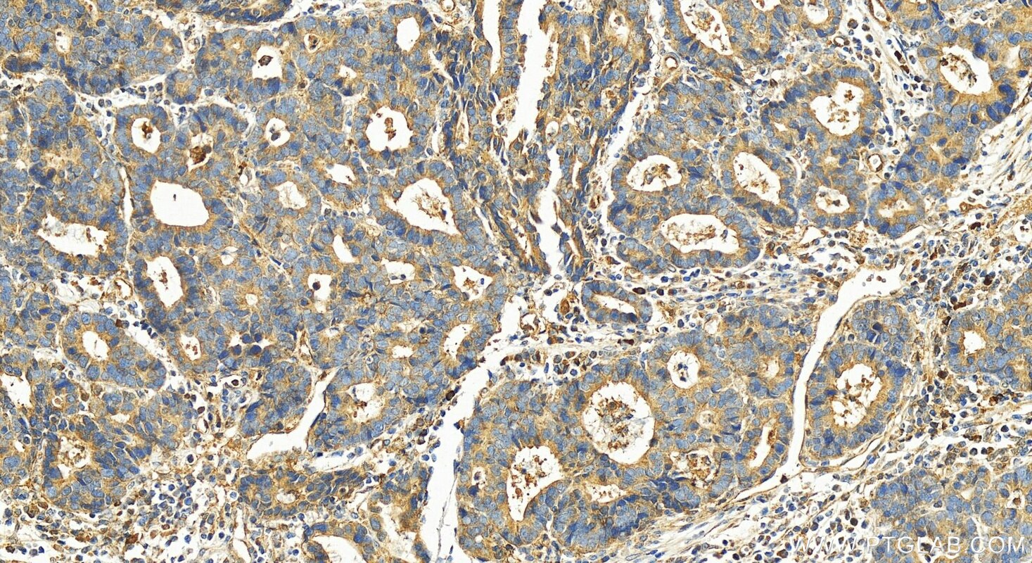 Immunohistochemistry (IHC) staining of human stomach cancer tissue using SP6 Polyclonal antibody (28561-1-AP)