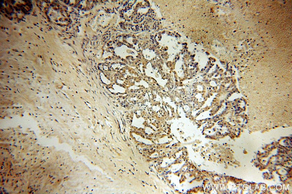 Immunohistochemistry (IHC) staining of human ovary tumor tissue using SPA17 Polyclonal antibody (13367-1-AP)