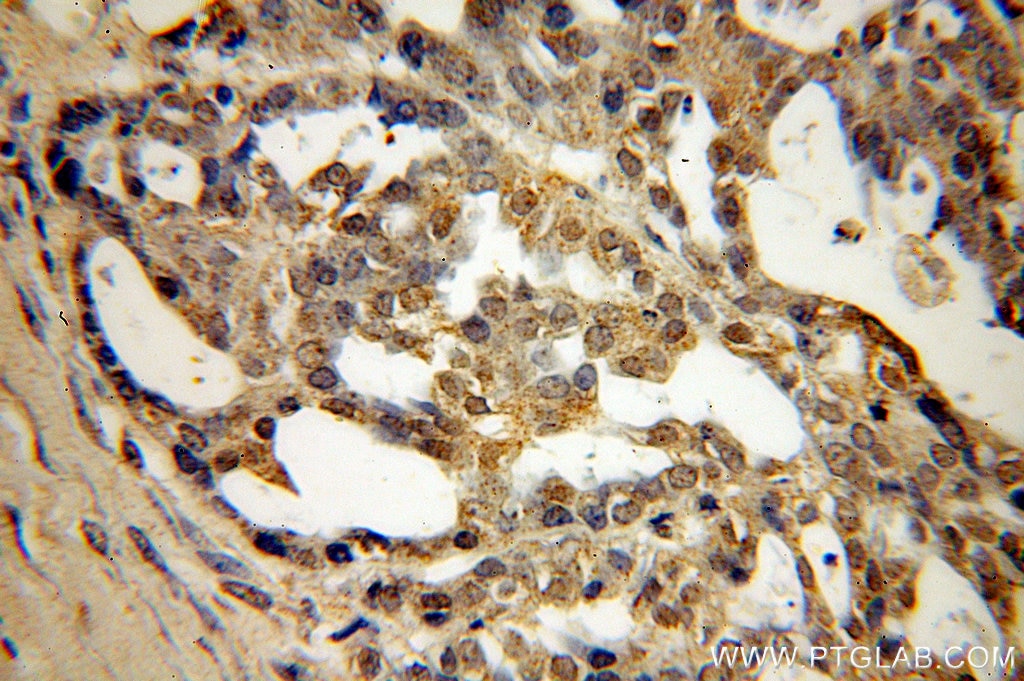 Immunohistochemistry (IHC) staining of human ovary tumor tissue using SPA17 Polyclonal antibody (13367-1-AP)