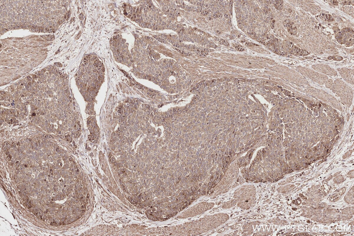 Immunohistochemistry (IHC) staining of human stomach cancer tissue using SPAG5 Polyclonal antibody (14726-1-AP)