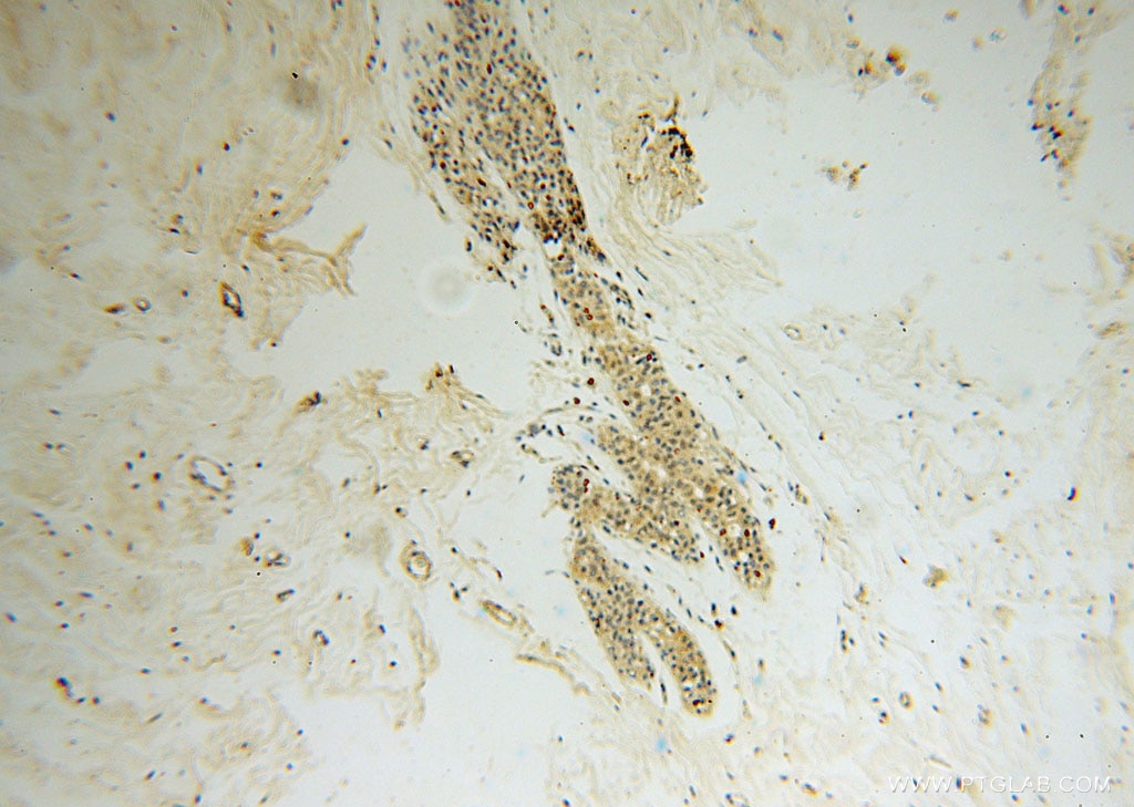 Immunohistochemistry (IHC) staining of human colon cancer tissue using SPAG7 Polyclonal antibody (16294-1-AP)