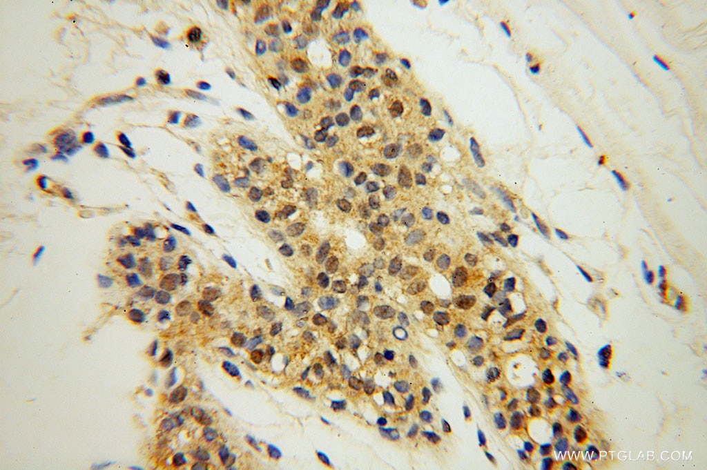 Immunohistochemistry (IHC) staining of human colon cancer tissue using SPAG7 Polyclonal antibody (16294-1-AP)