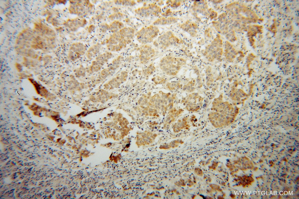 Immunohistochemistry (IHC) staining of human prostate cancer tissue using SPAG8 Polyclonal antibody (13915-1-AP)