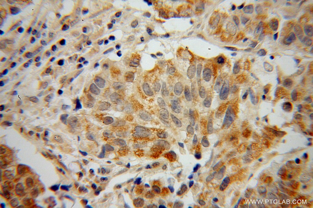 Immunohistochemistry (IHC) staining of human prostate cancer tissue using SPAG8 Polyclonal antibody (13915-1-AP)