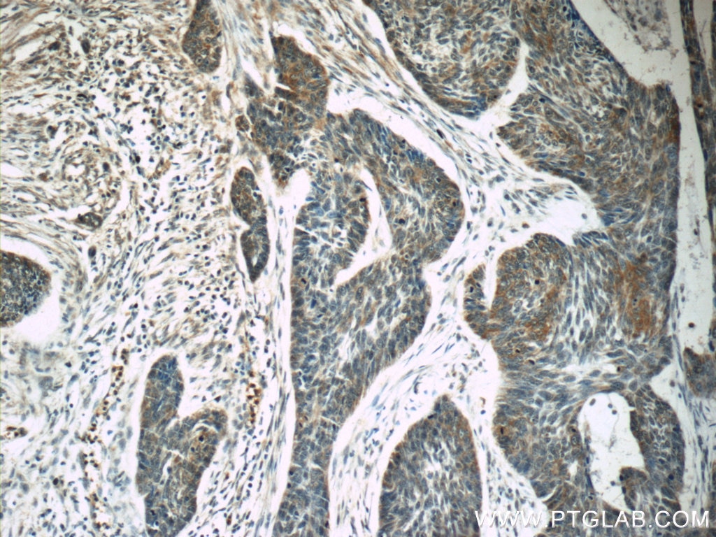 Immunohistochemistry (IHC) staining of human skin cancer tissue using SPANXA2/SPANXA1 Polyclonal antibody (19527-1-AP)