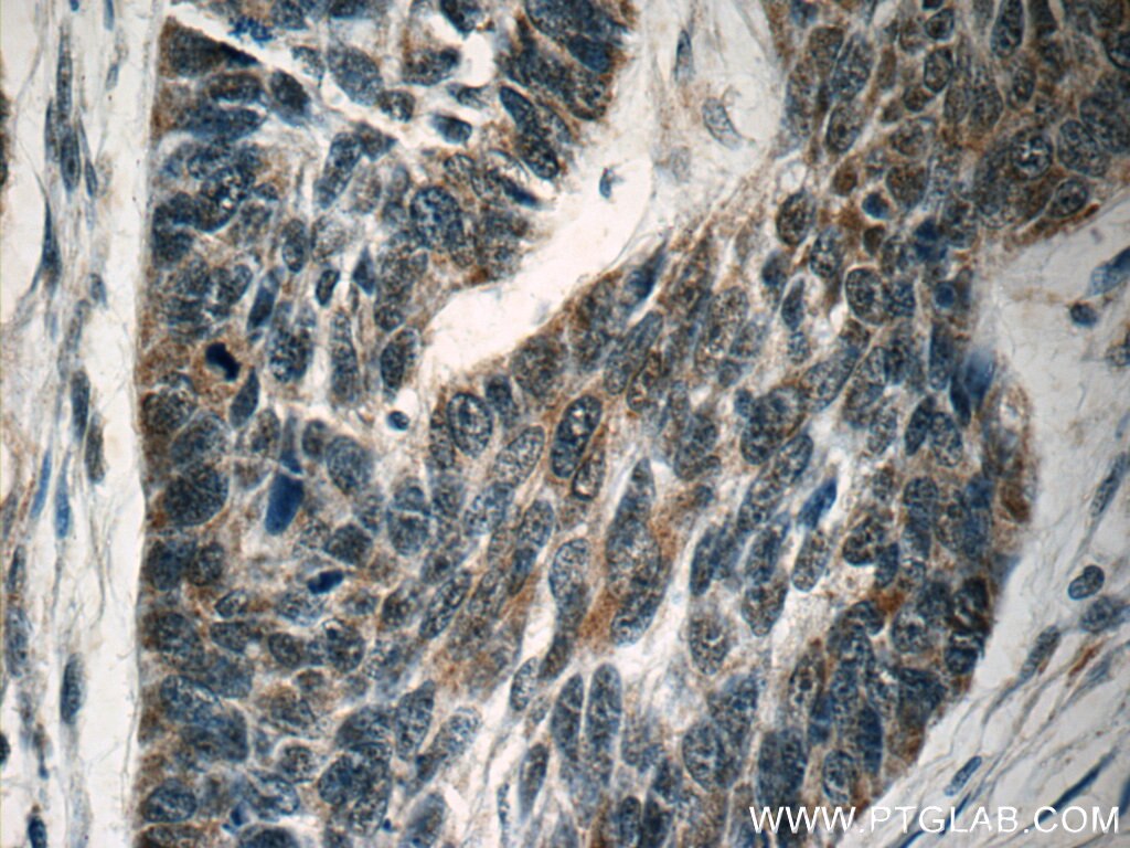 Immunohistochemistry (IHC) staining of human skin cancer tissue using SPANXA2/SPANXA1 Polyclonal antibody (19527-1-AP)