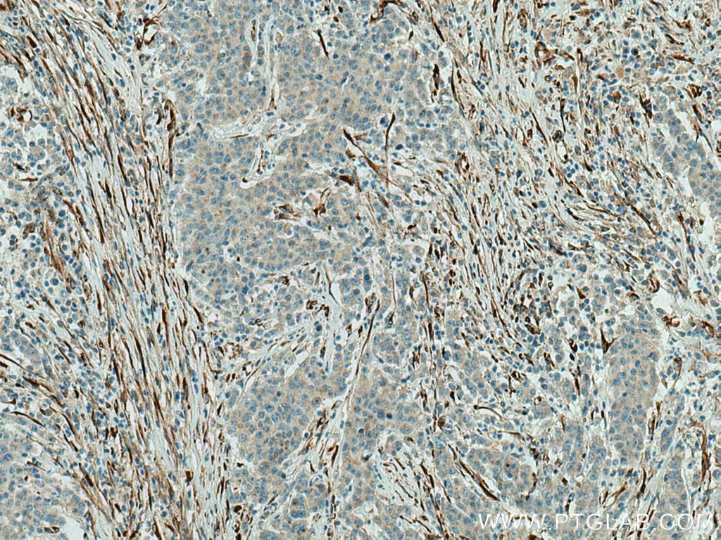 Immunohistochemistry (IHC) staining of human stomach cancer tissue using SPARC Polyclonal antibody (15274-1-AP)